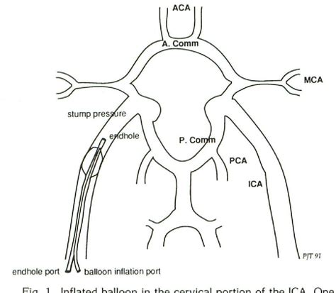 carotid compression test for therapeutic occlusion|balloon occlusion testing.